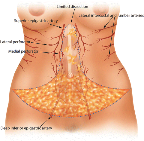 Blood Supply of the Abdominoplasty