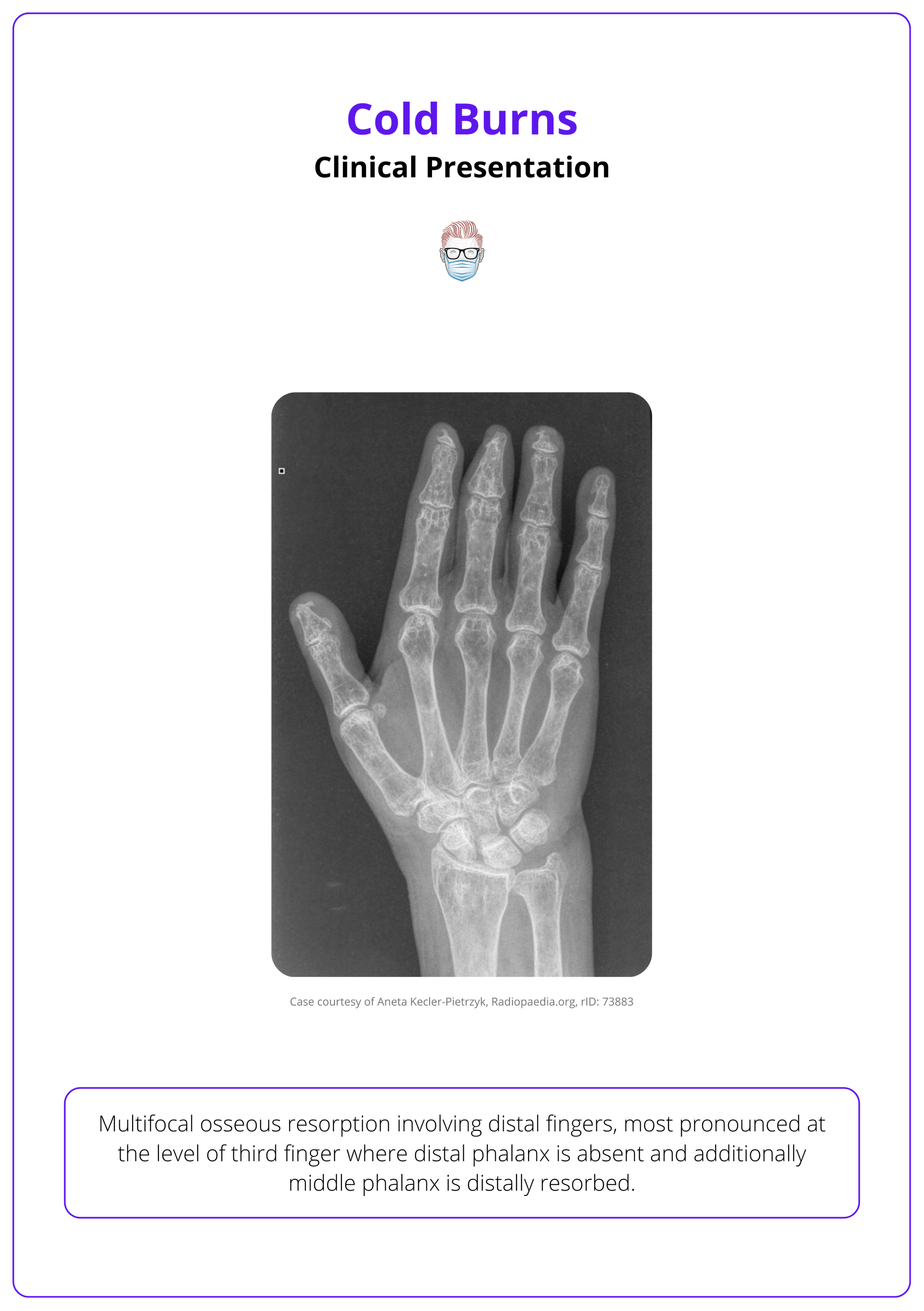 X-ray image of a hand frostbite, clinical presentation of frostbite