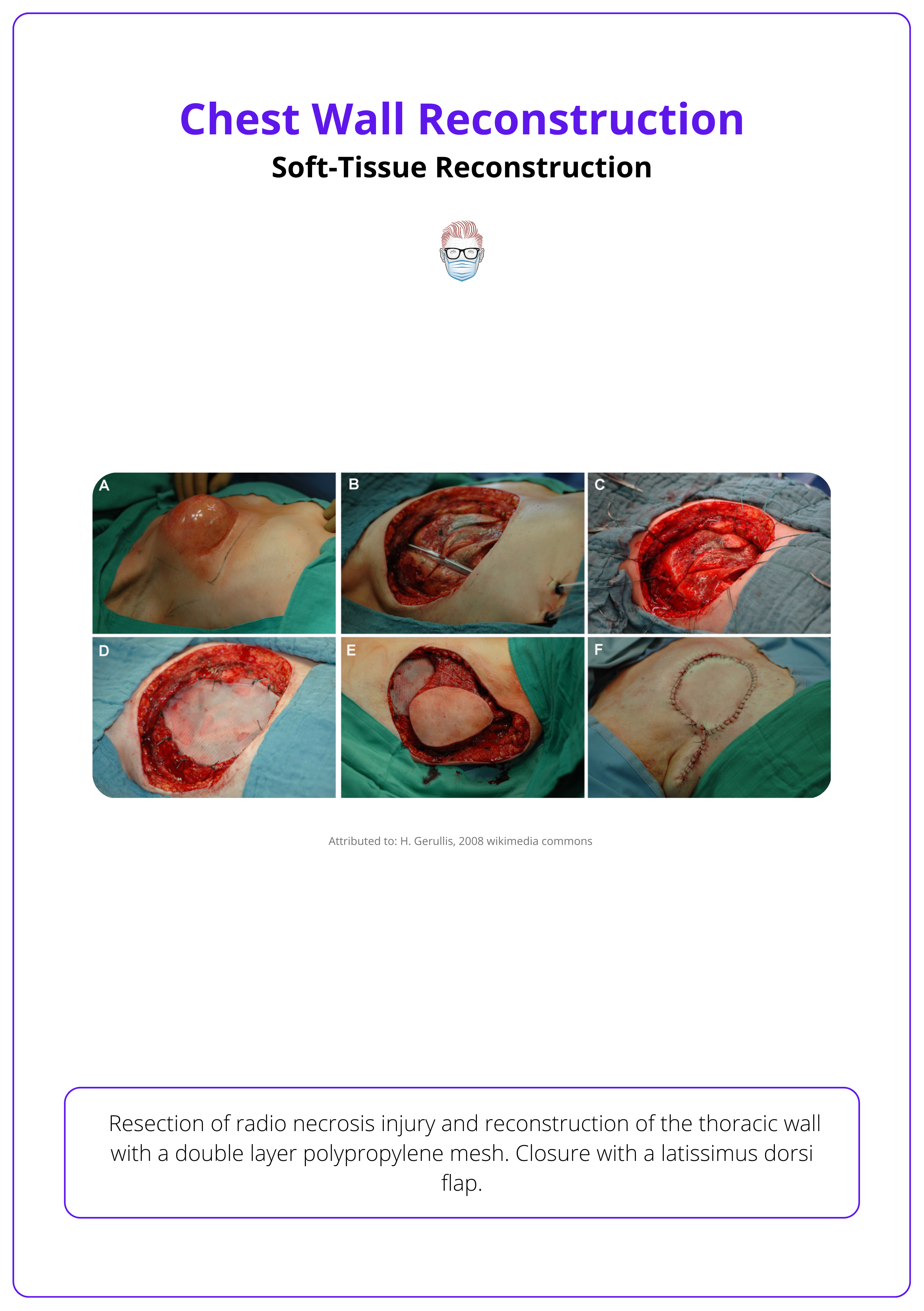 The use of flaps for chest wall reconstruction