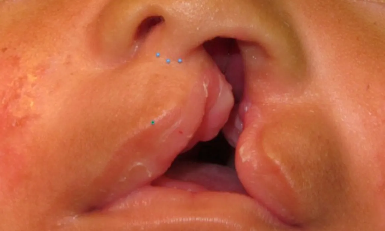Marking a cleft lip