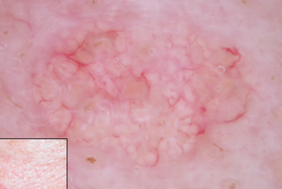 Dermoscopy: Sebaceous Hyperplasia vs BCC