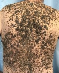 Identifying Seborrhoeic Keratoses