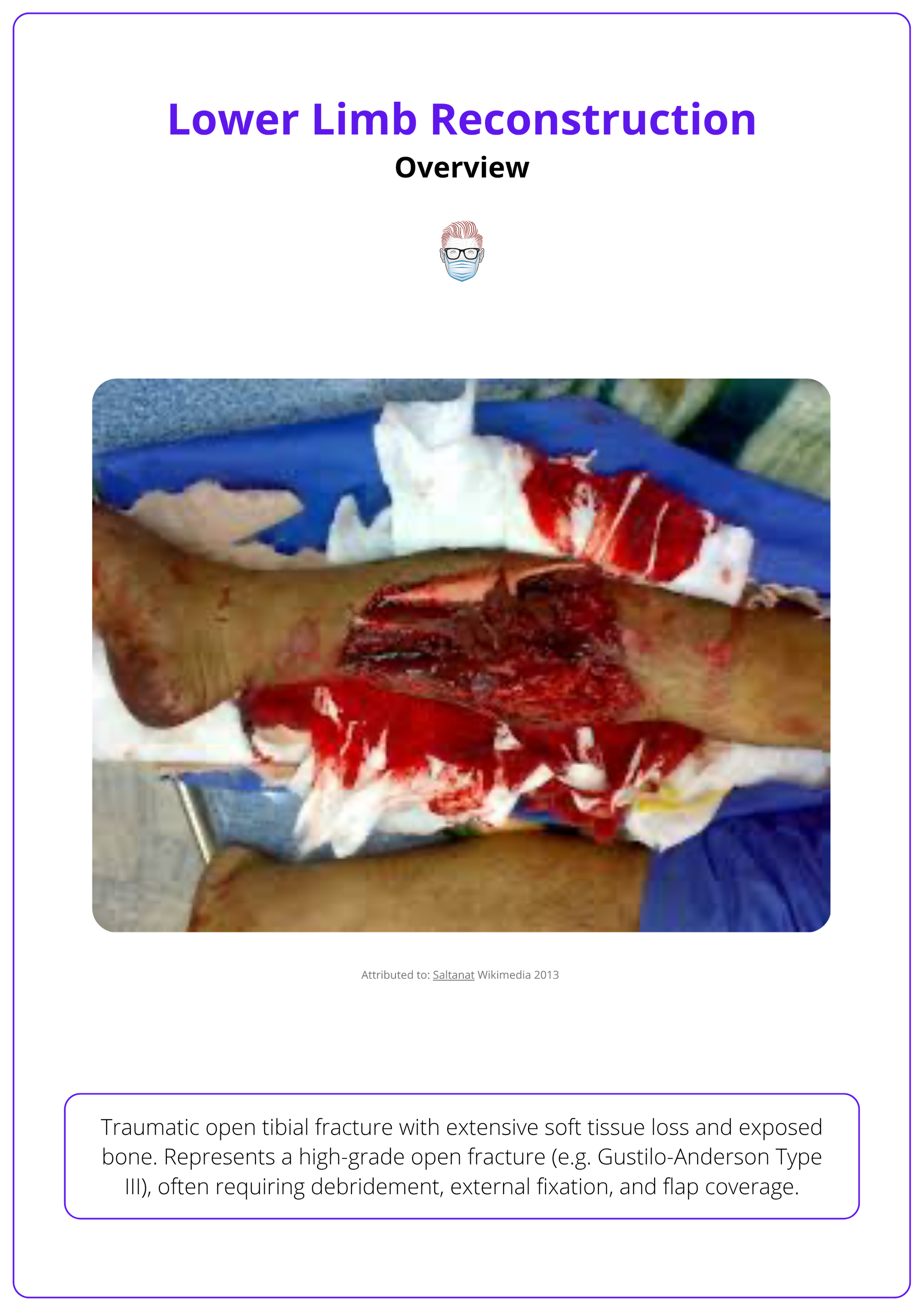 A traumatic open tibial fracture with extensive soft tissue loss