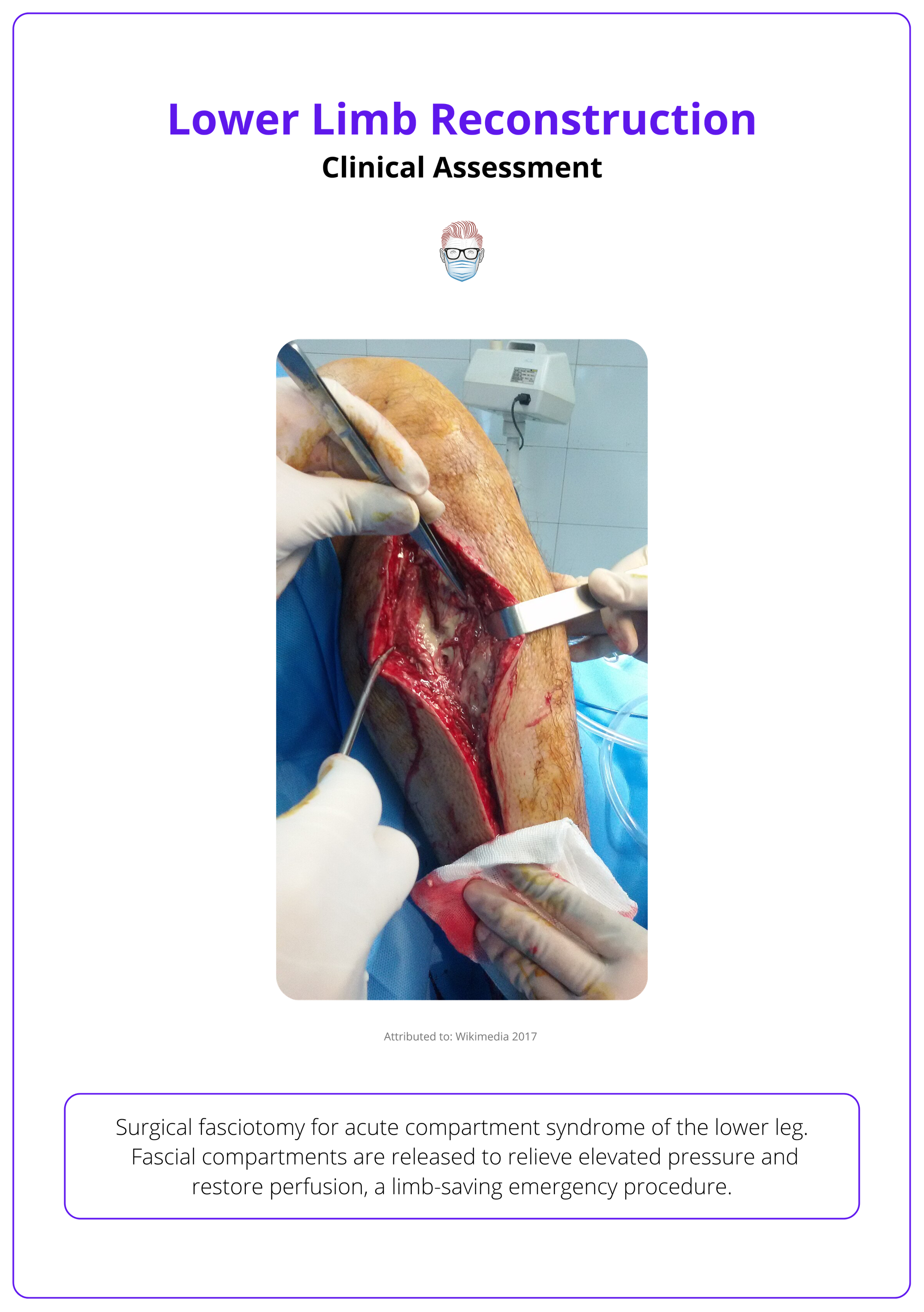 Acute compartment syndrome of the lower leg