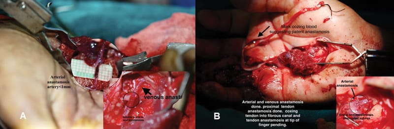 Vascularised Tendon Graft