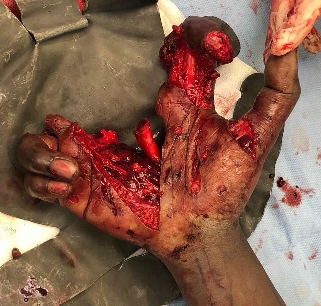 Firework Hand Injury