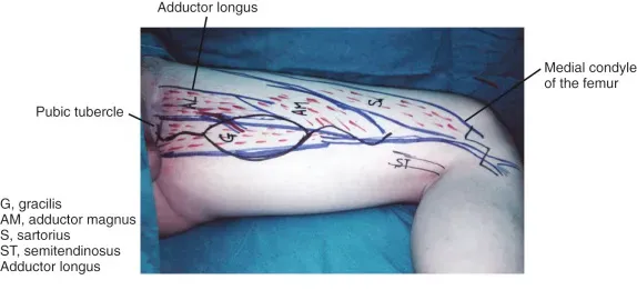 Surface markings for harvesting a gracilis flap - lower limb reconstruction