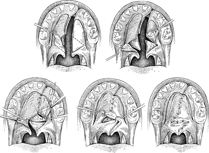 Levator Sling in Cleft Palate Repair