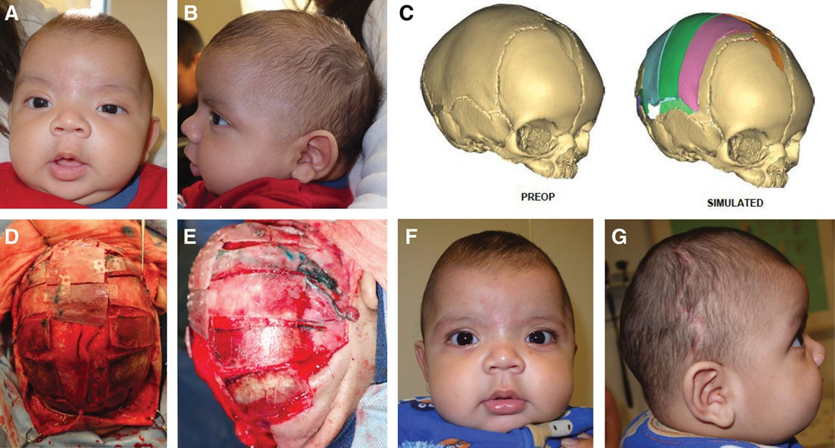Sagittal Craniosynostosis - Preoperative 3D CT