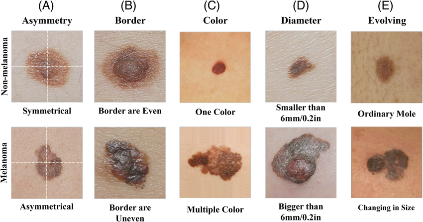 The ABCDEs of Melanoma Detection