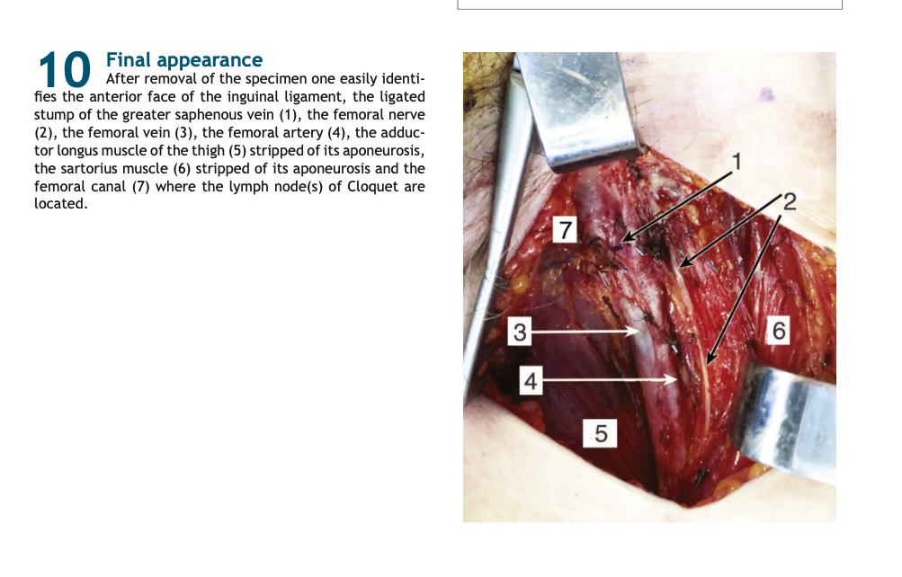 Inguinal Lymph Node Dissection