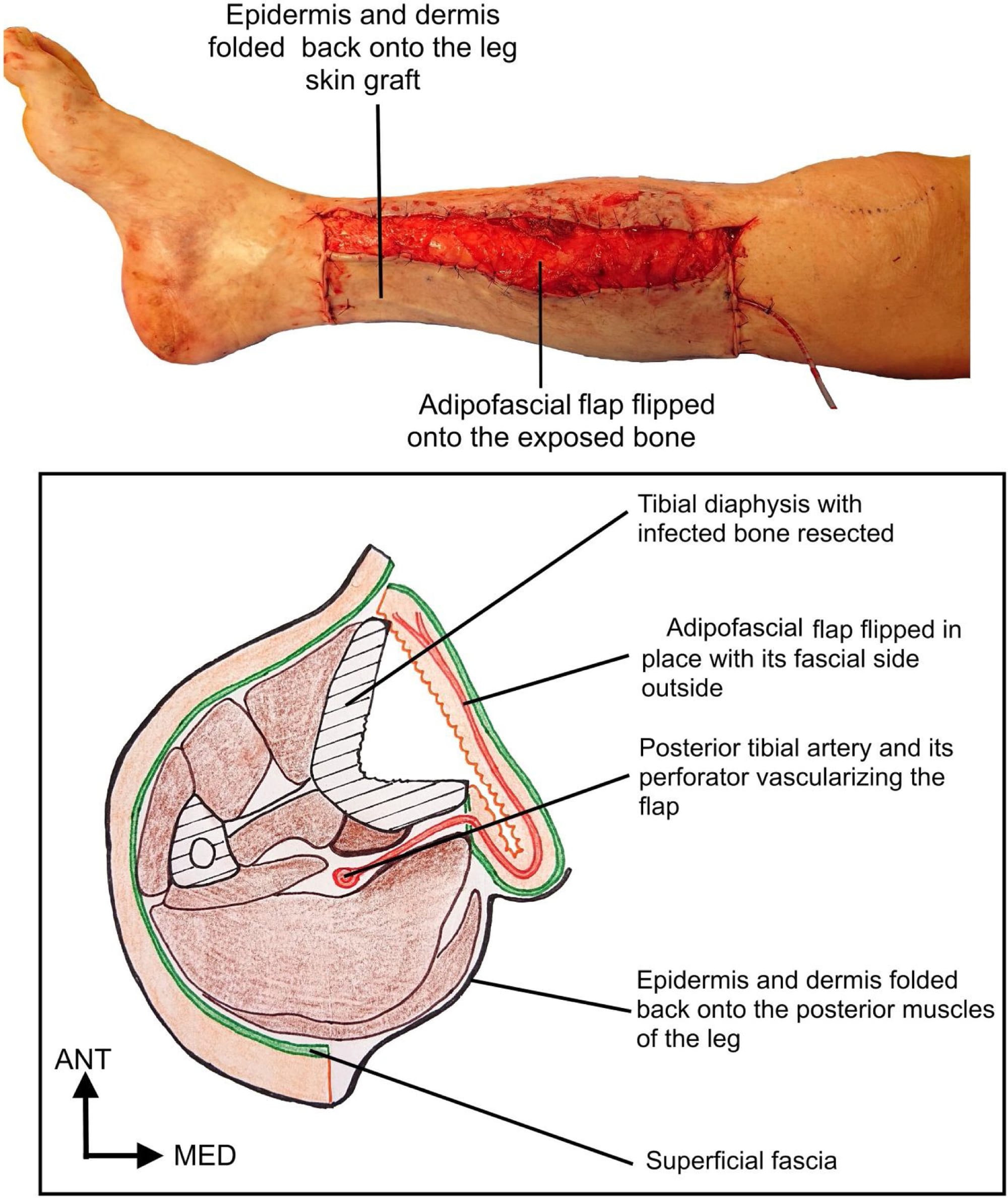 Adipofascial Flap for Salvaging Exposed Tibia
