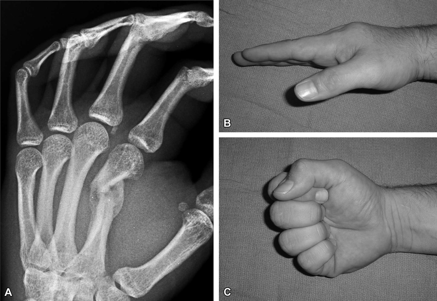 Metacarpal Fracture