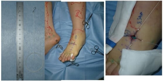 Supermicrosurgical Exposure in Lymphaticovenular Anastomosis