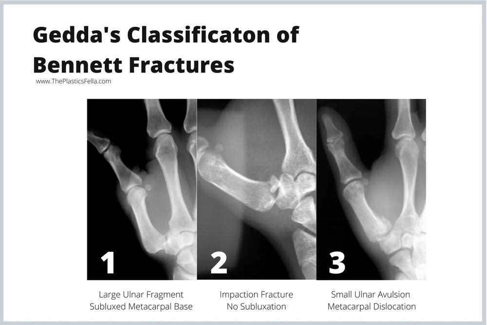 Fracture XRays, Diagnosis, Treatment.
