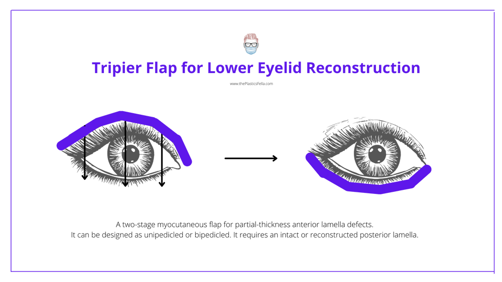 Lower Eyelid Reconstruction · Algorithm, Techniques & Illustrations