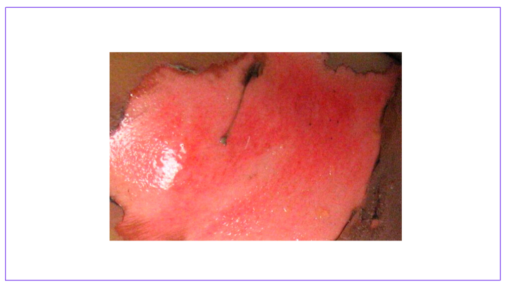 Burn Depth Classification, Assessment, Characteristics.