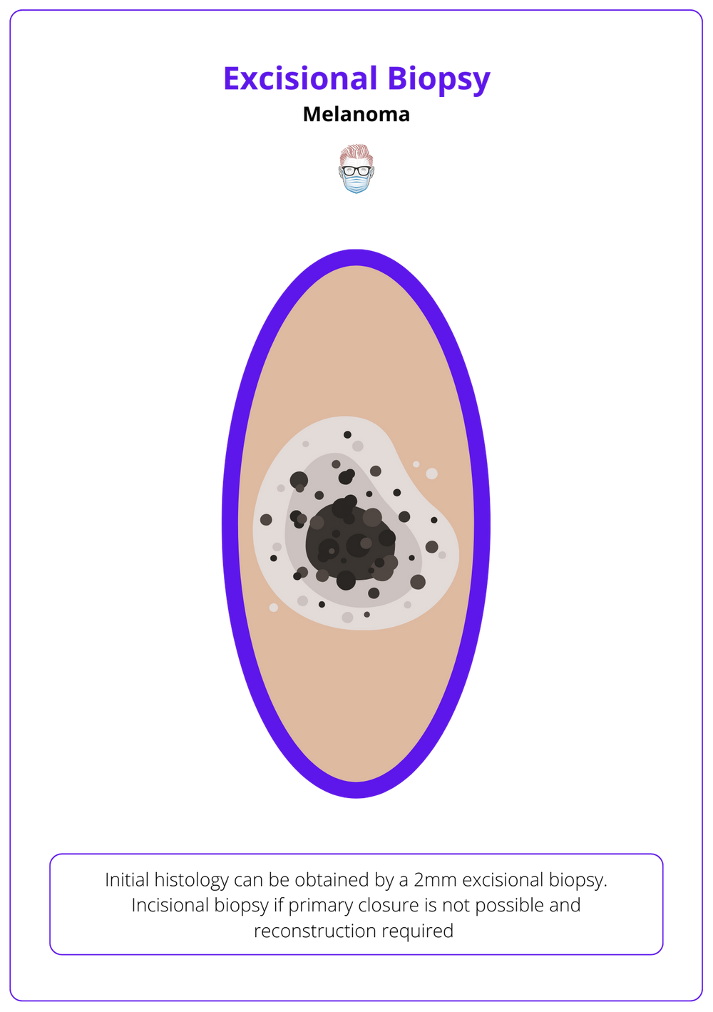 Melanoma Diagnosis, Features, Sentinel Node, & Staging