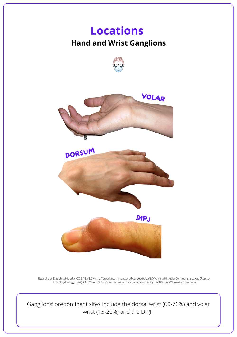 Ganglion Cysts of the Hand & Wrist Diagnosis and Treatment