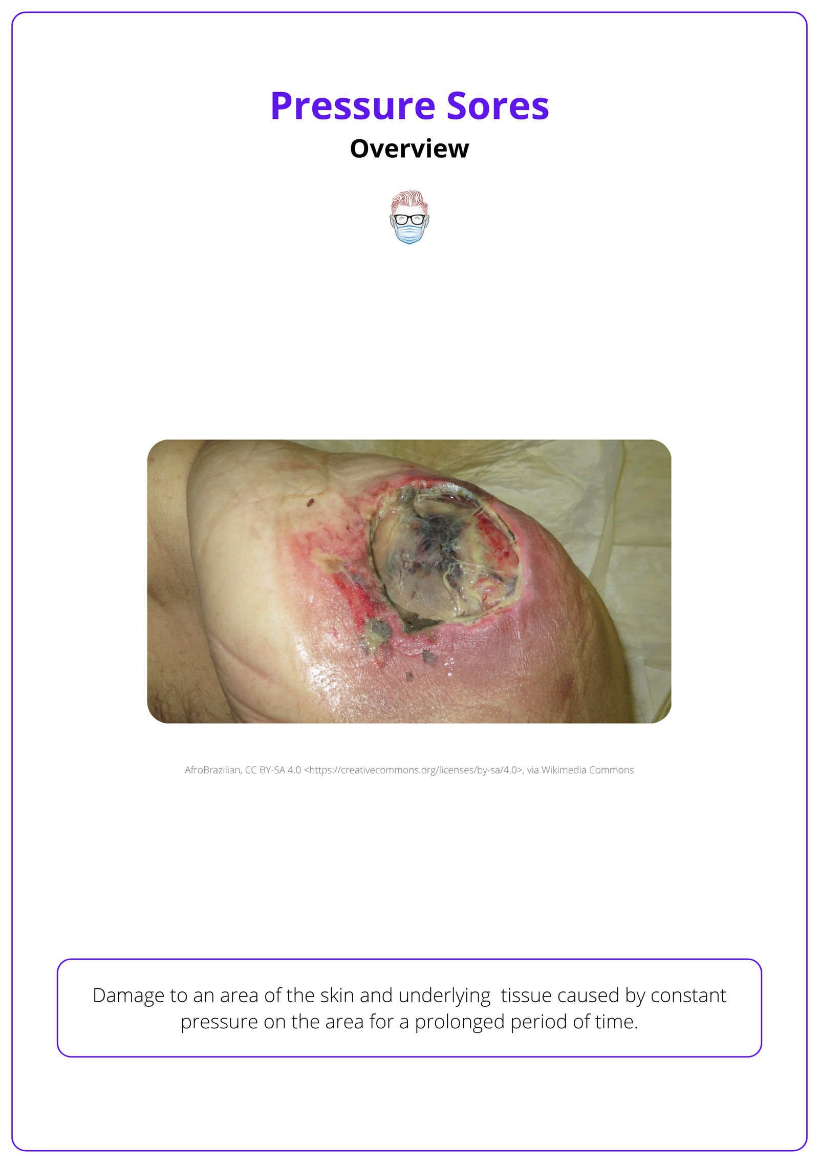 Pressure Sores: Causes, Clinical Assessment, & Management
