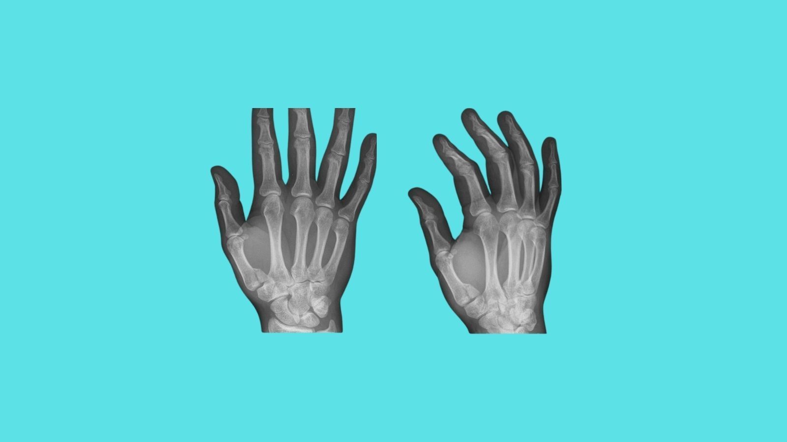 Fracture XRays, Diagnosis, Treatment.
