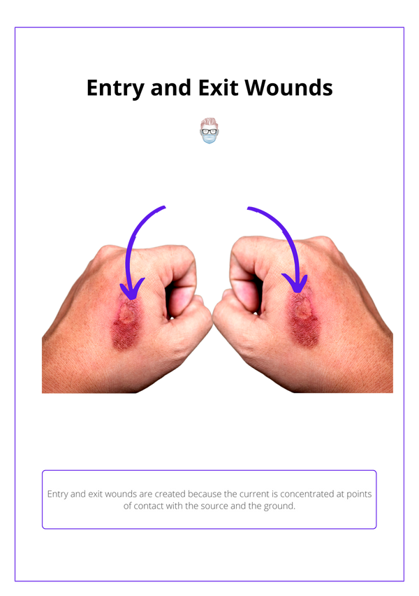 Electrical Burns · Causes, Complications, Management