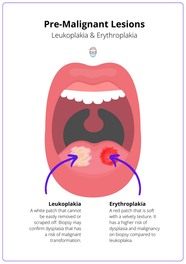 Oral Cavity Tumours · Types, Staging, Treatment, Anatomy