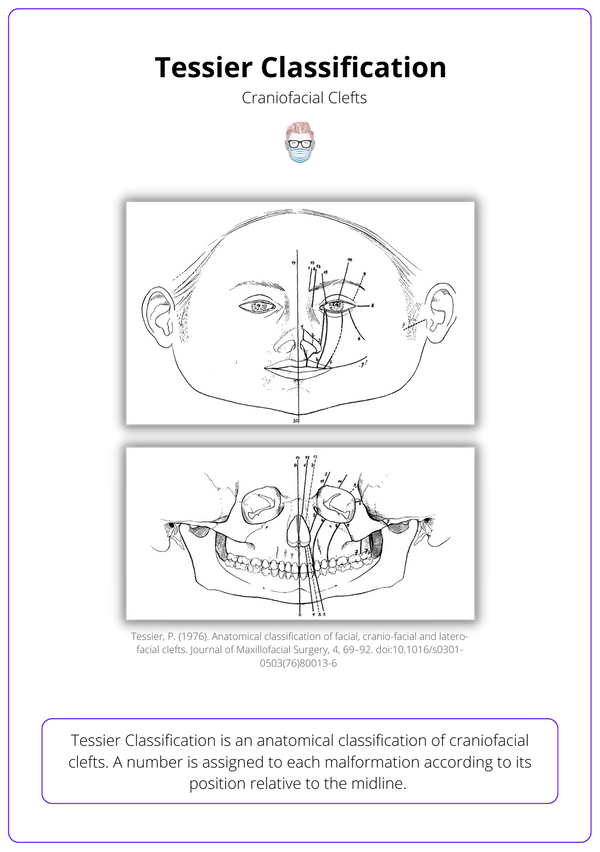 Craniofacial Clefts · Tessier Classification, Types, Management