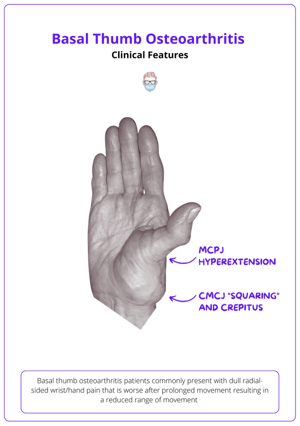 Basal Thumb Osteoarthritis Anatomy, Pathophysiology, Diagnosis, Treatment