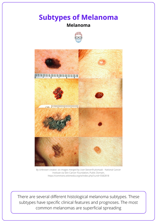 Melanoma Diagnosis Features Sentinel Node Staging melanoma-diagnosis-features-sentinel-node-staging